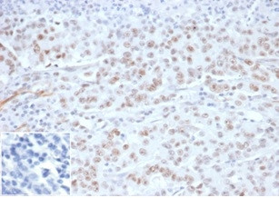 MLH1 (MUTL HOMOLOG 1)/HNPCC AN