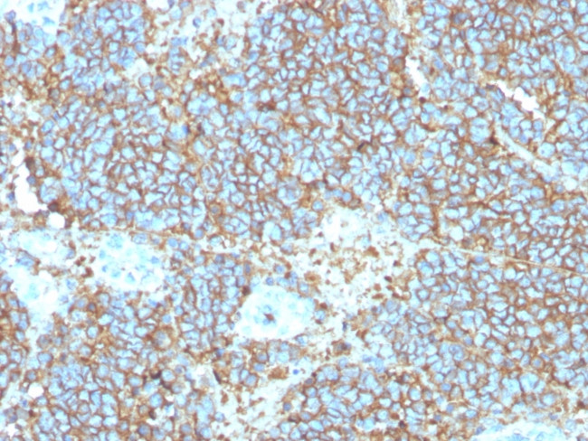 CD99/MIC2 (EWING‘S SARCOMA MAR