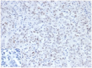MLH1 (MUTL HOMOLOG 1)/HNPCC AN