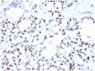 MLH1 (MUTL HOMOLOG 1)/HNPCC AN