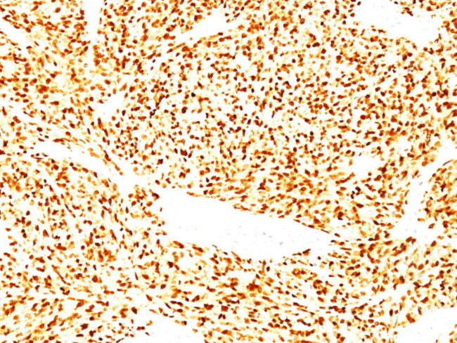 MYOD1 (RHABDOMYOSARCOMA MARKER