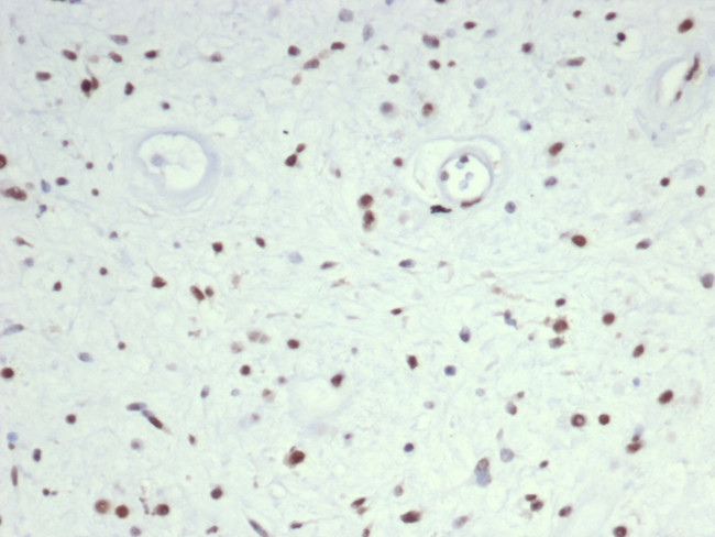 MYOD1 (RHABDOMYOSARCOMA MARKER