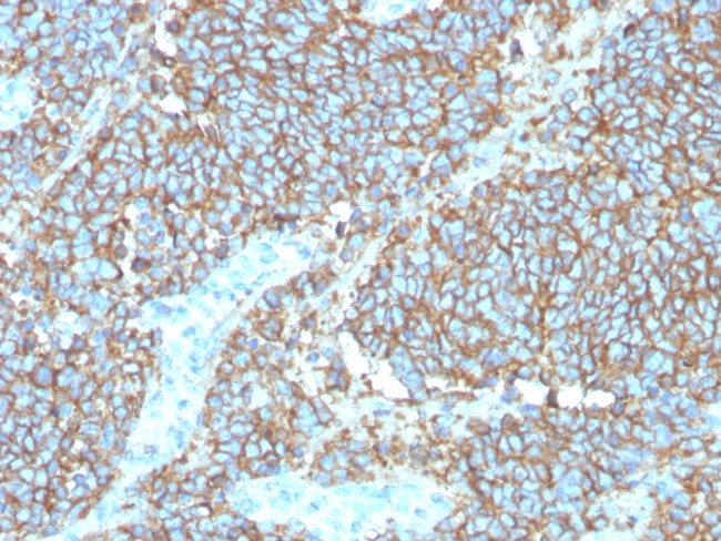CD99/MIC2 (EWING‘S SARCOMA MAR