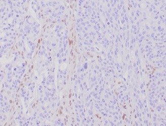 MLH1 (MUTL HOMOLOG 1)/HNPCC AN