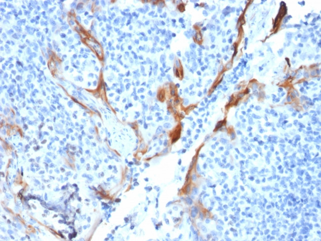 CYTOKERATIN 16 (KRT16)